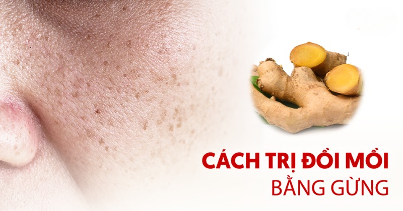 7 cách trị đồi mồi bằng gừng hiệu quả nhưng ít người áp dụng