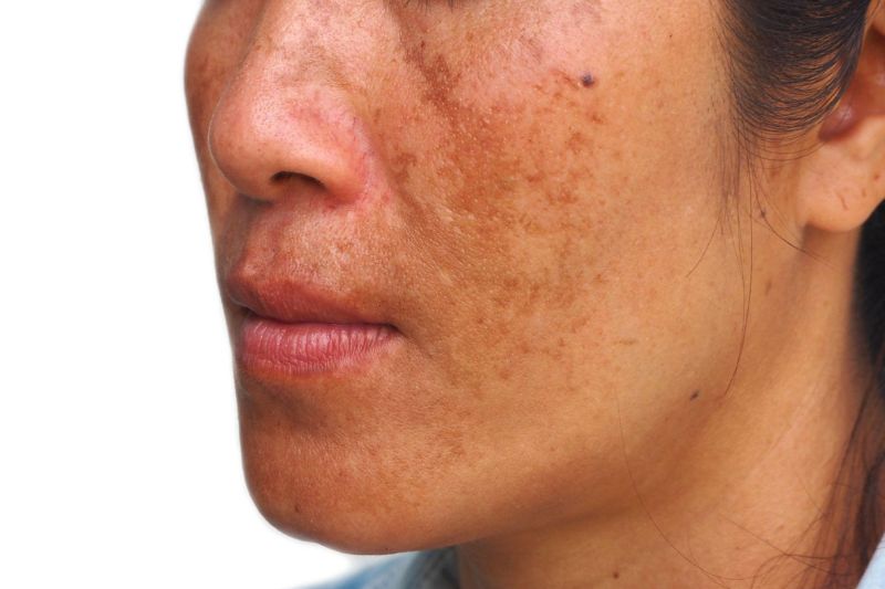 trị nám bằng laser bao nhiêu tiền phụ thuộc vào nhiều yếu tố