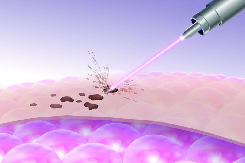bắn tia laser trị đồi mồi giúp cải thiện cấu trúc da
