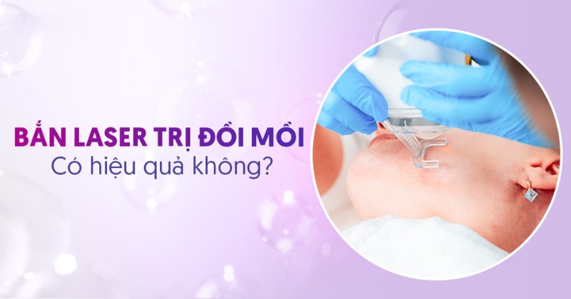 bắn laser trị đồi mồi