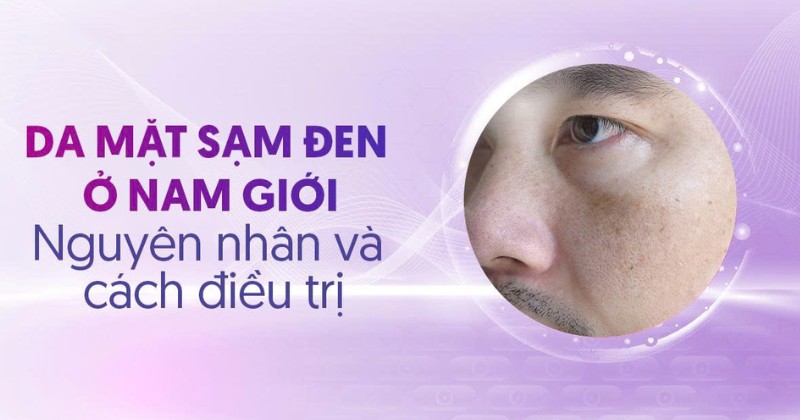 Da mặt sạm đen ở nam giới: Nguyên nhân và cách điều trị hiệu quả