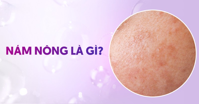 Nám nông là gì? Nguyên nhân, cách nhận biết và điều trị
