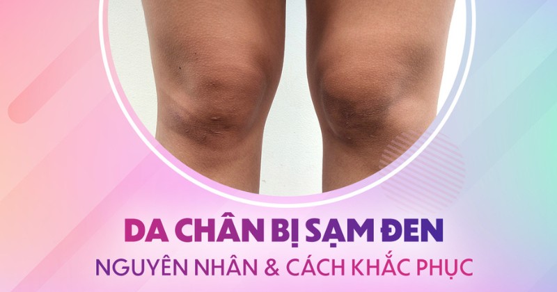 Nguyên nhân da chân bị sạm đen và cách khắc phục hiệu quả