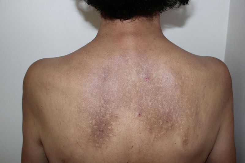 da lưng bị thâm sạm đen 