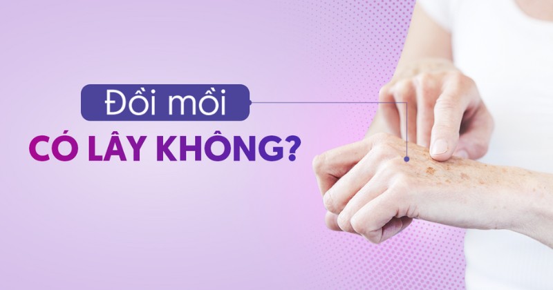 Bệnh đồi mồi có lây không? Có di truyền không?