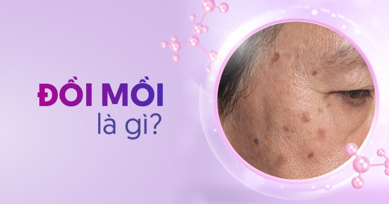 đồi mồi là gì
