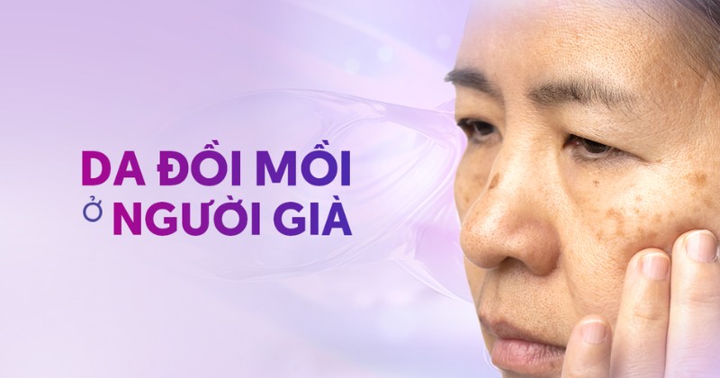 Tại sao đồi mồi ở người già thường phức tạp? Khắc phục ra sao?