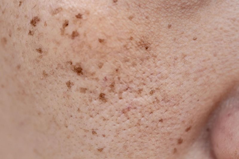 đồi mồi là vẫn đề da liễu không phải bệnh lý