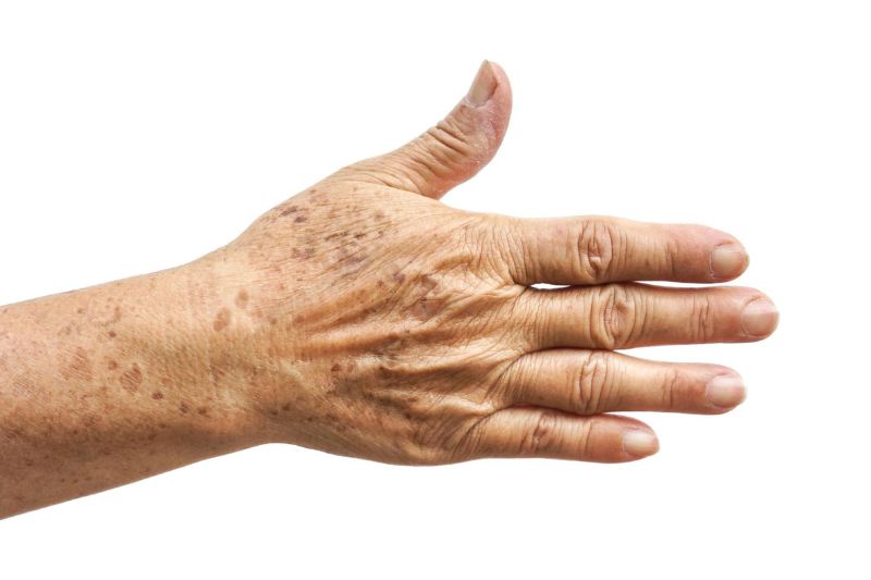 đồi mồi xuất hiện trên bàn tay