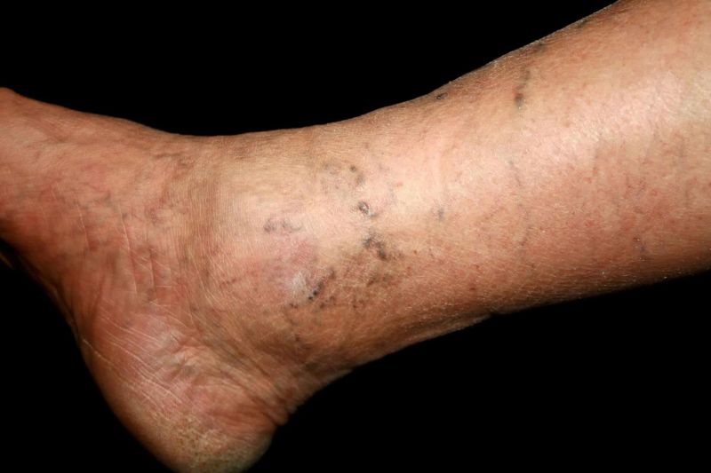 bệnh lý về da ở chân cũng làm da chân thâm sạm