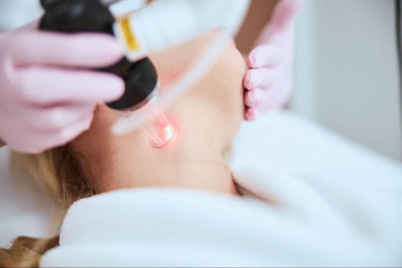 bán tia laser trị da sạm đen