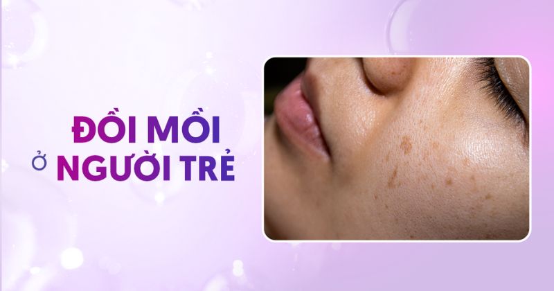 Tại sao đồi mồi ở người trẻ lại xuất hiện sớm? Khắc phục ra sao?