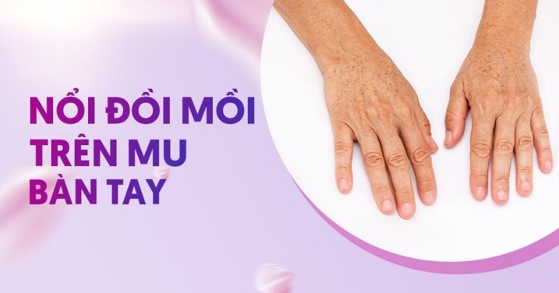 Nổi đồi mồi trên mu bàn tay cần phải loại bỏ như thế nào?