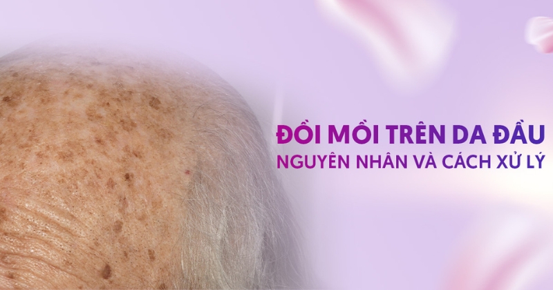 Vì sao bị trổ đồi mồi trên da đầu? Khắc phục như thế nào?