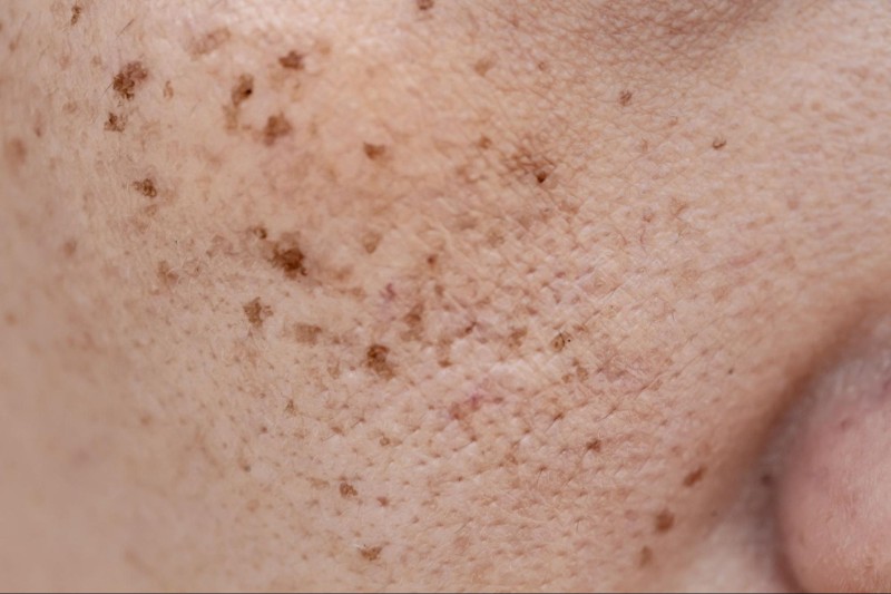 đốm đồi mồi trên da mặt