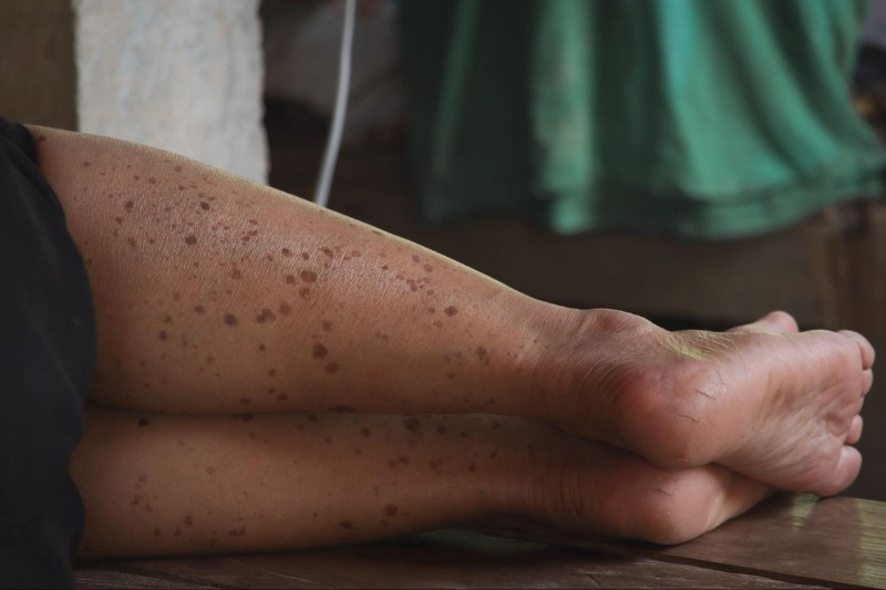 vết đồi mồi ở chân