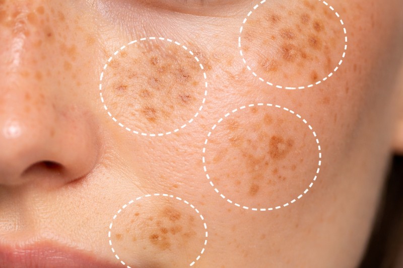 hình dạng đốm nâu