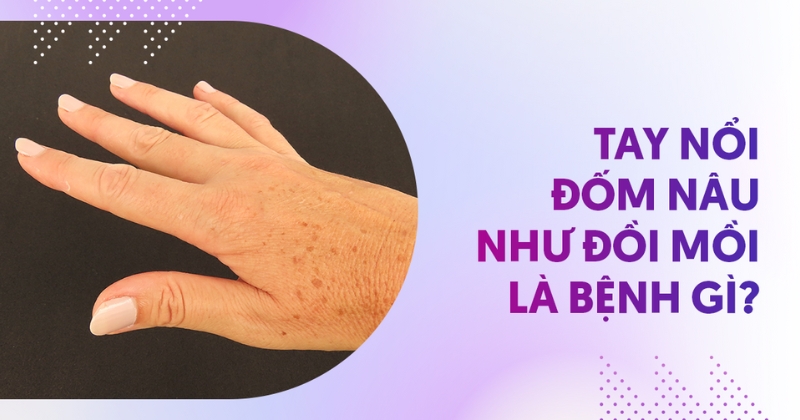 Tay nổi đốm nâu như đồi mồi là bệnh gì? Có đáng lo ngại không?
