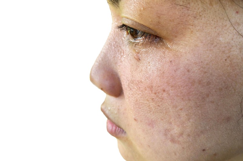 ảnh da sạm đen do nội tiết tố thay đổi