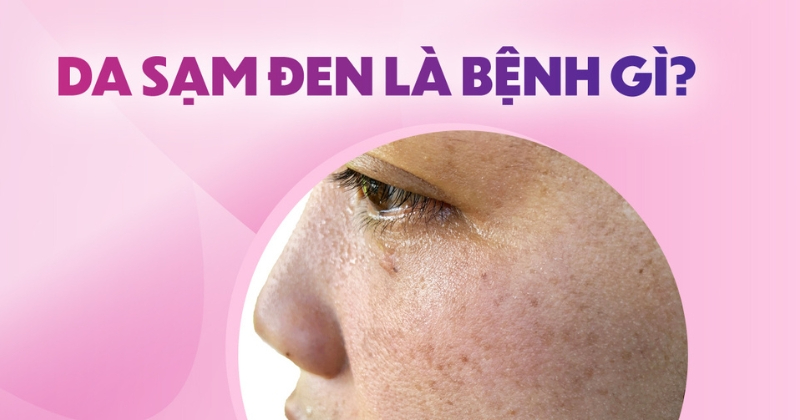 Da sạm đen là bệnh gì? Biểu hiện và cách điều trị