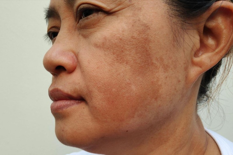 hình ảnh da bị mặt bị sạm đen