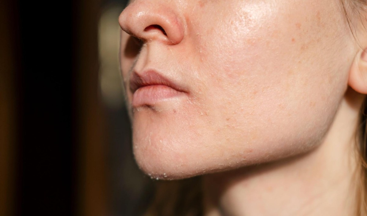 da khô thiếu ẩm ra nắng dễ đen