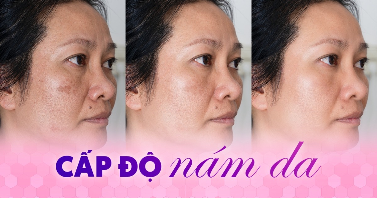 Xác định các cấp độ nám da cụ thể như thế nào?