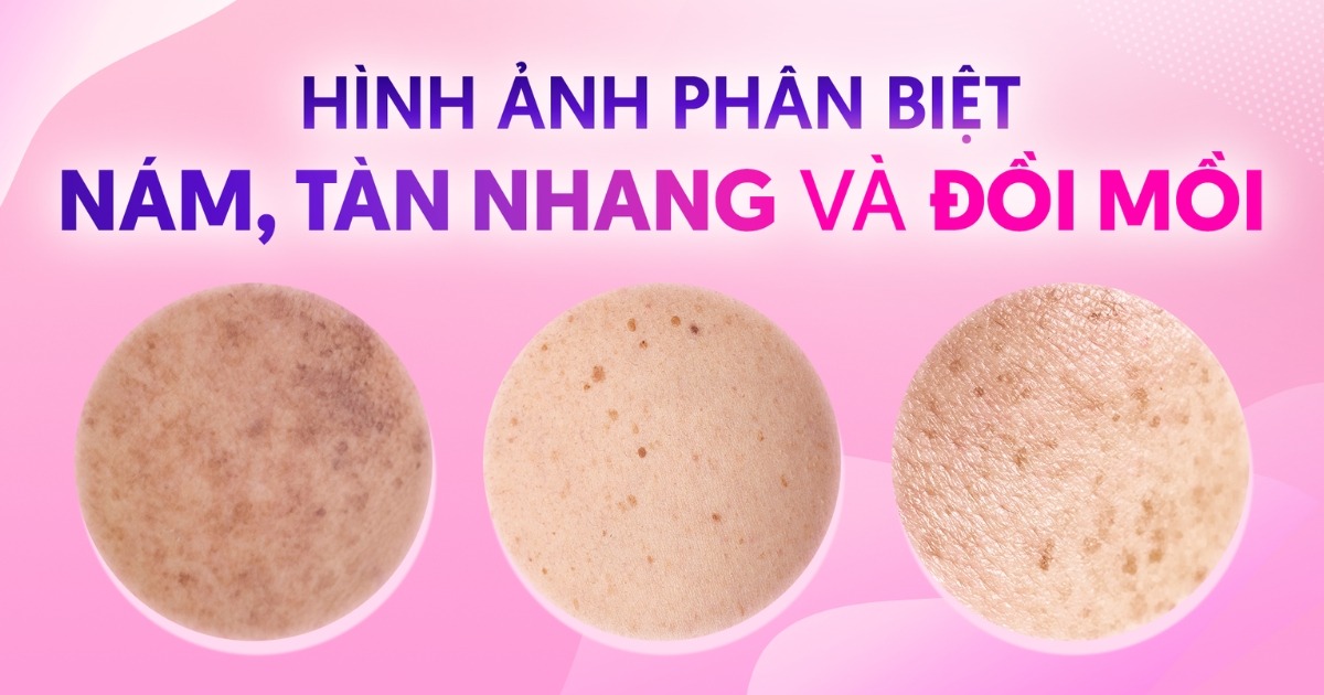 Cách phân biệt nám, tàn nhang và đồi mồi kèm hình ảnh chi tiết
