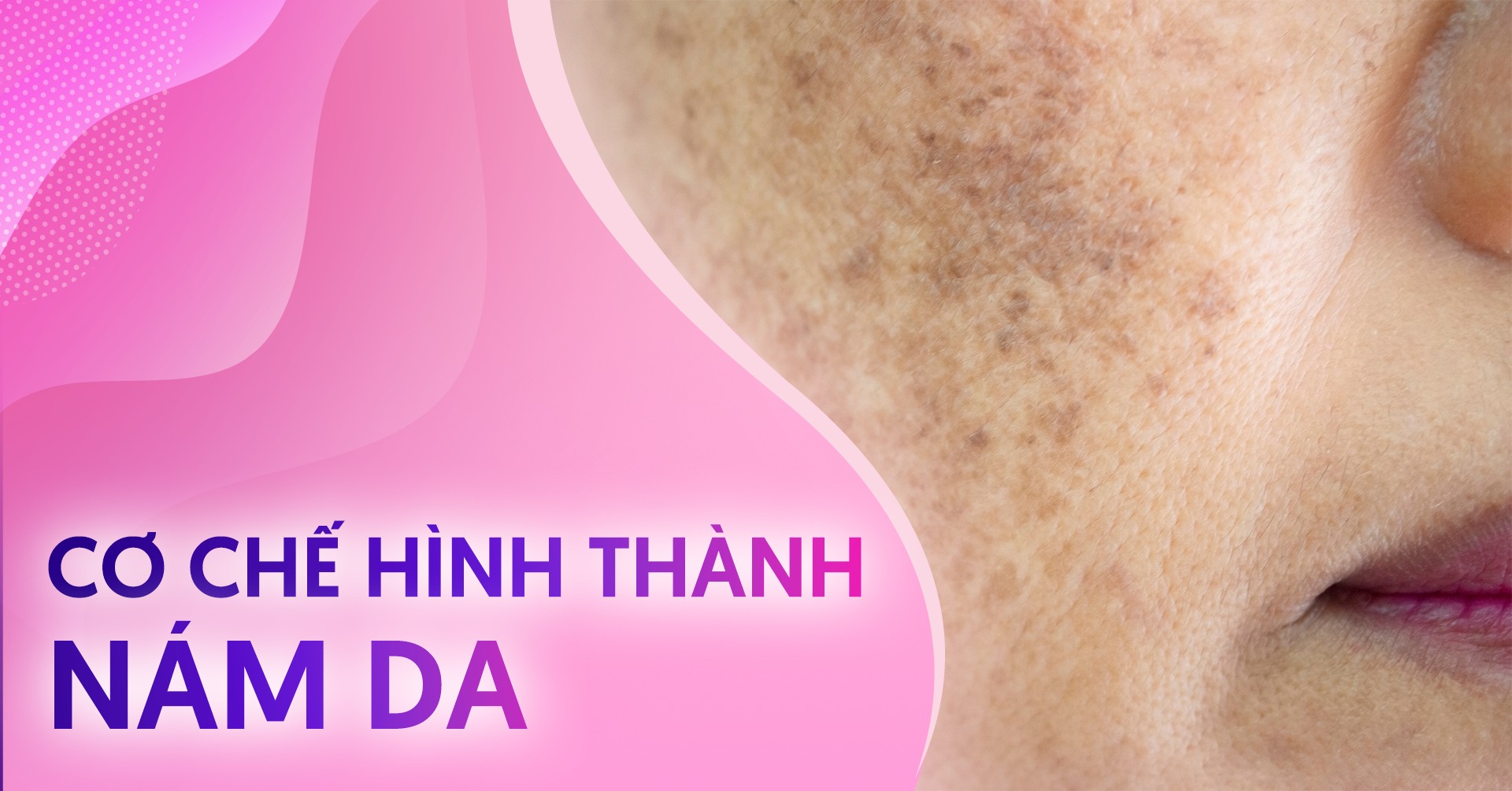 cơ chế hình thành nám da