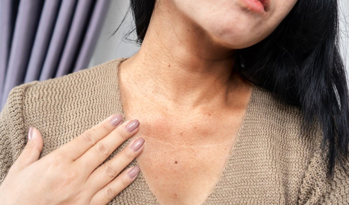 da dưới cằm bị sạm có thể lan ra vùng cổ