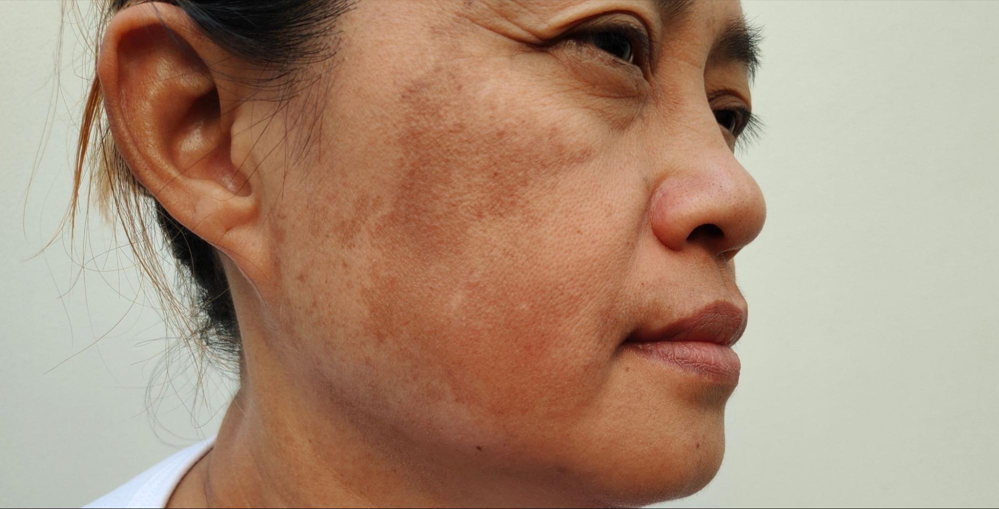 da bị nám khói sẫm màu