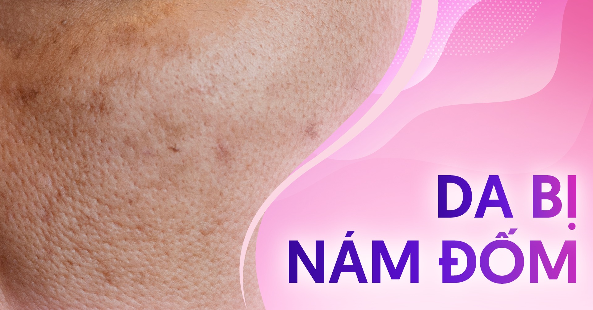 Nám đốm là gì? Đâu là cách cải thiện hiệu quả?