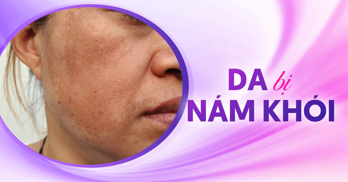 Nám khói là gì? Đâu là giải pháp xử lý?