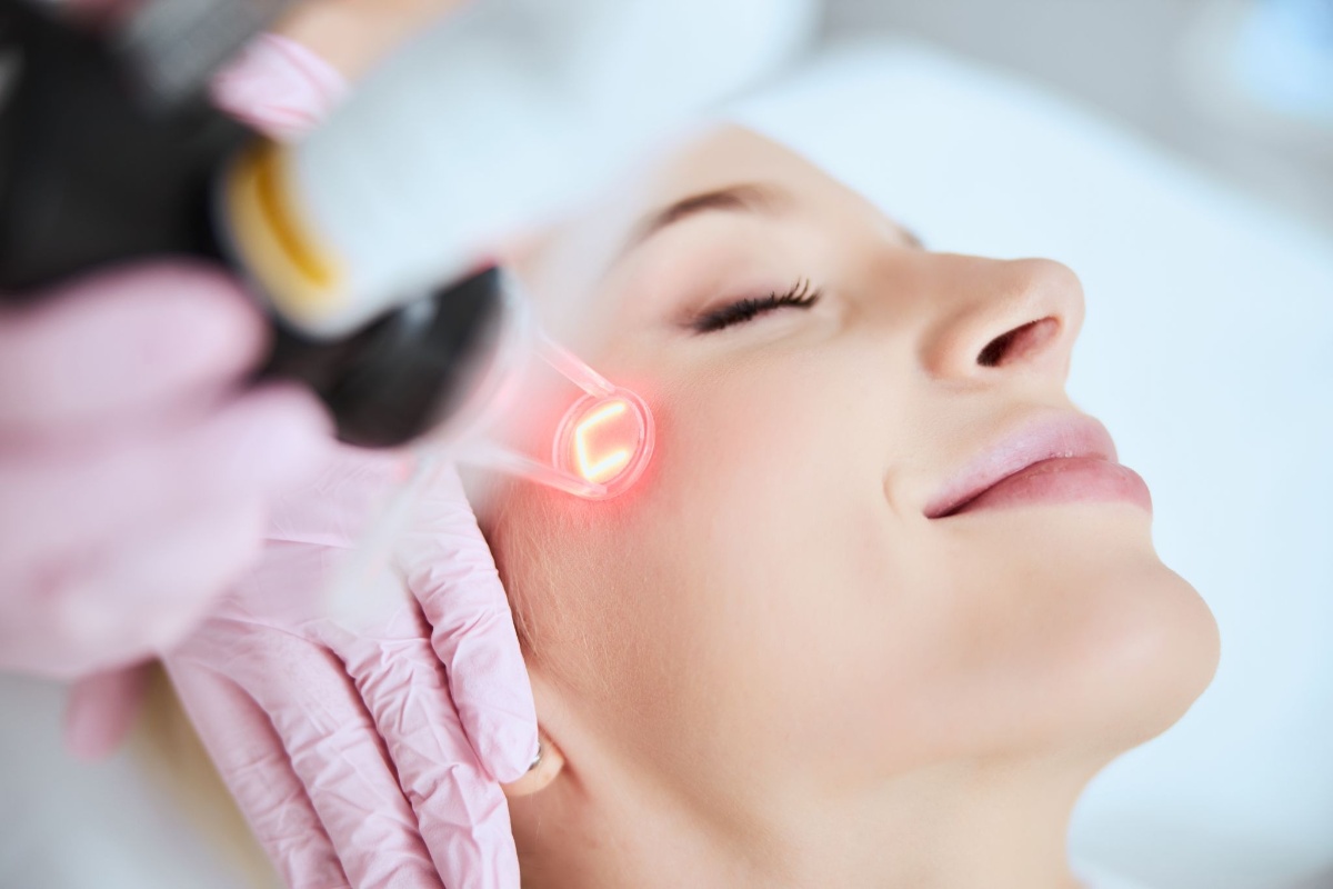 laser trị nám cánh bướm