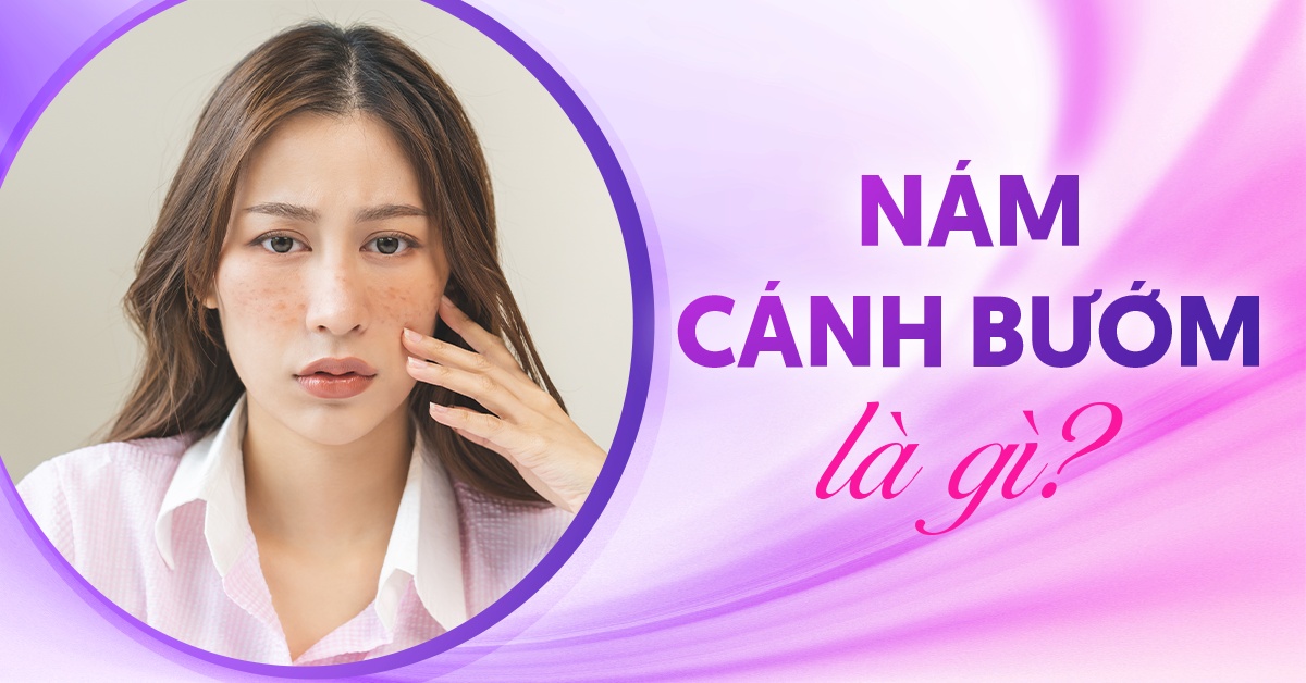 Nám cánh bướm và các thông tin cần biết