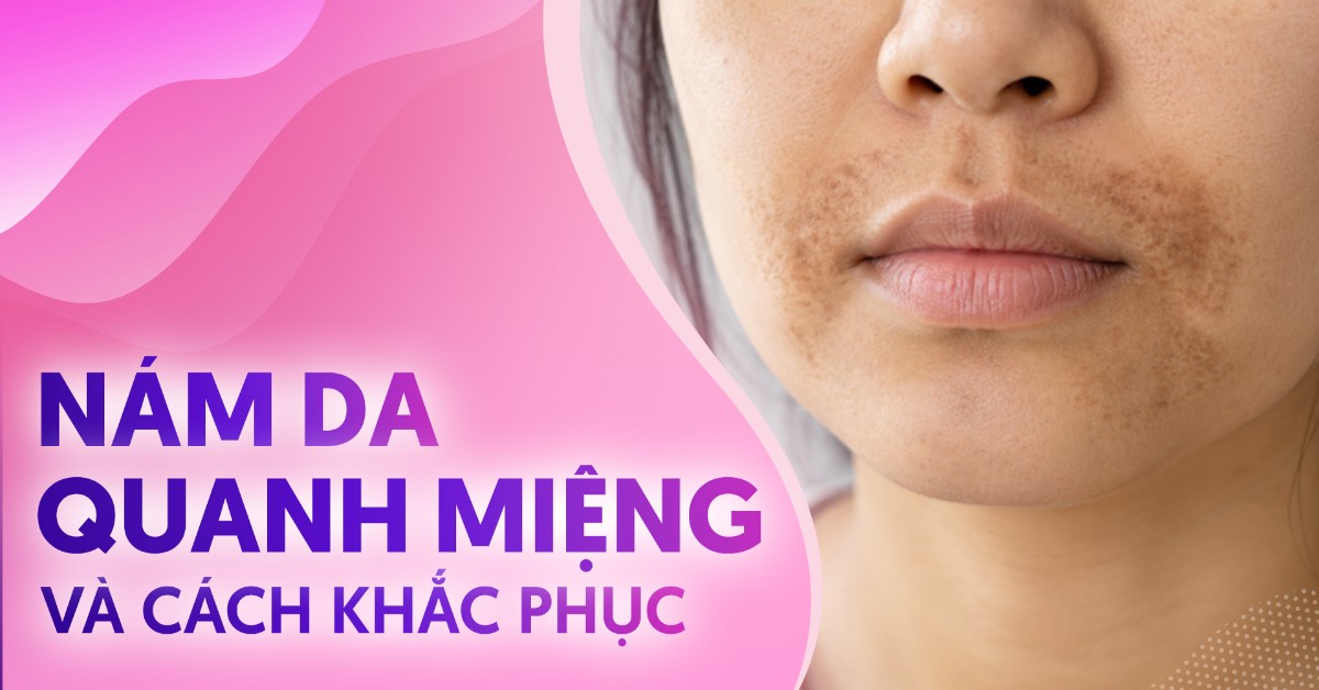 Nám da quanh miệng do đâu, nên khắc phục thế nào?