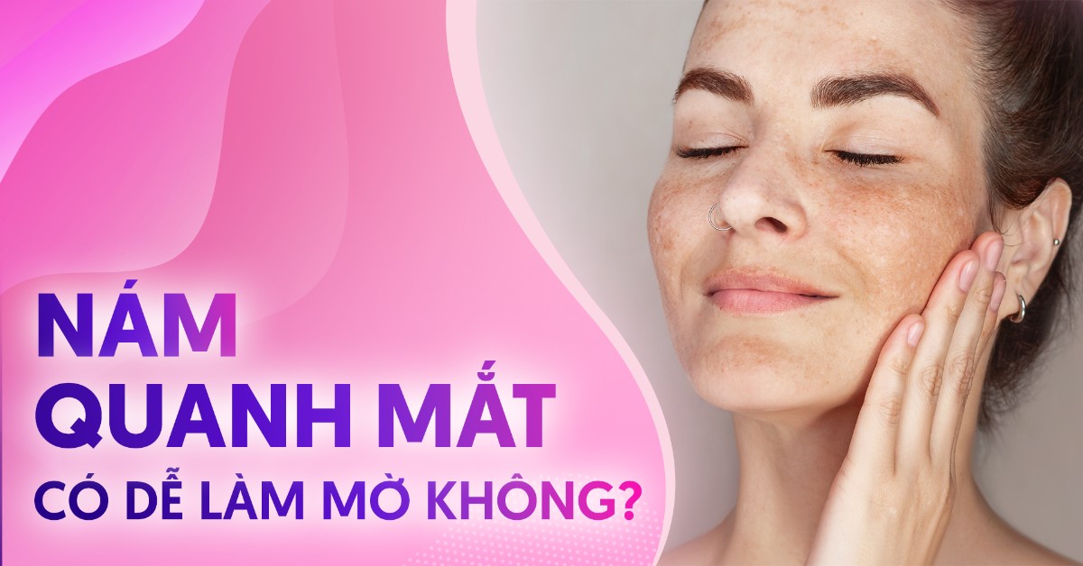 Nám quanh mắt và phương pháp cải thiện