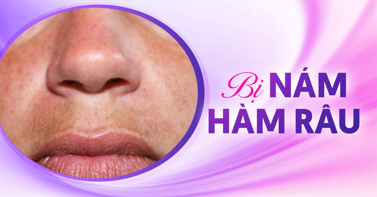 Nám râu ở mép và cách cải thiện hiệu quả