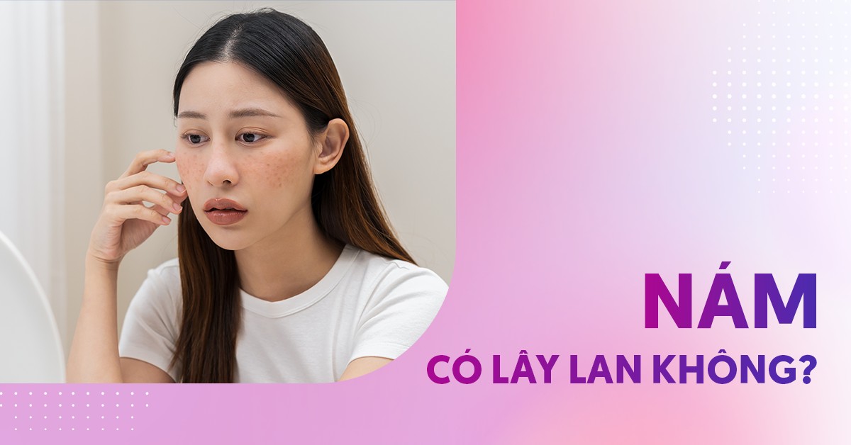 Nám có lây lan không? Sự thật thế nào?